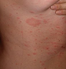 Behandlung von Pityriasis rosea